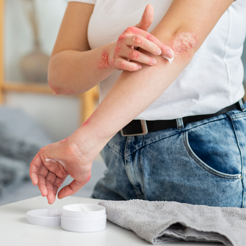 blogartikel-schuppenflechte_behandlungsmöglichkeiten